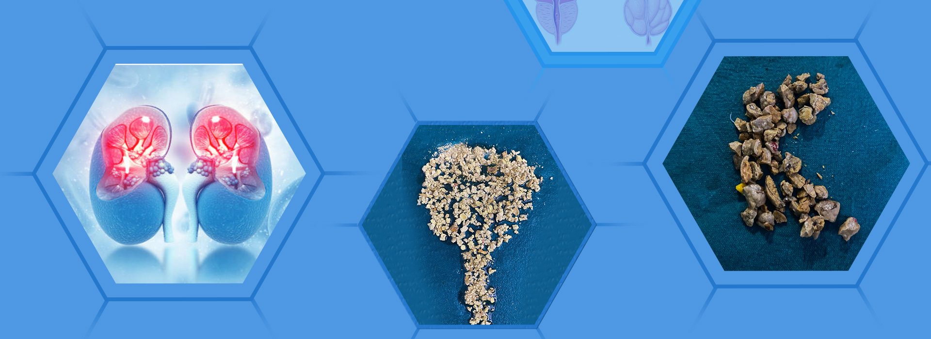 Kidney stones and affected kidneys