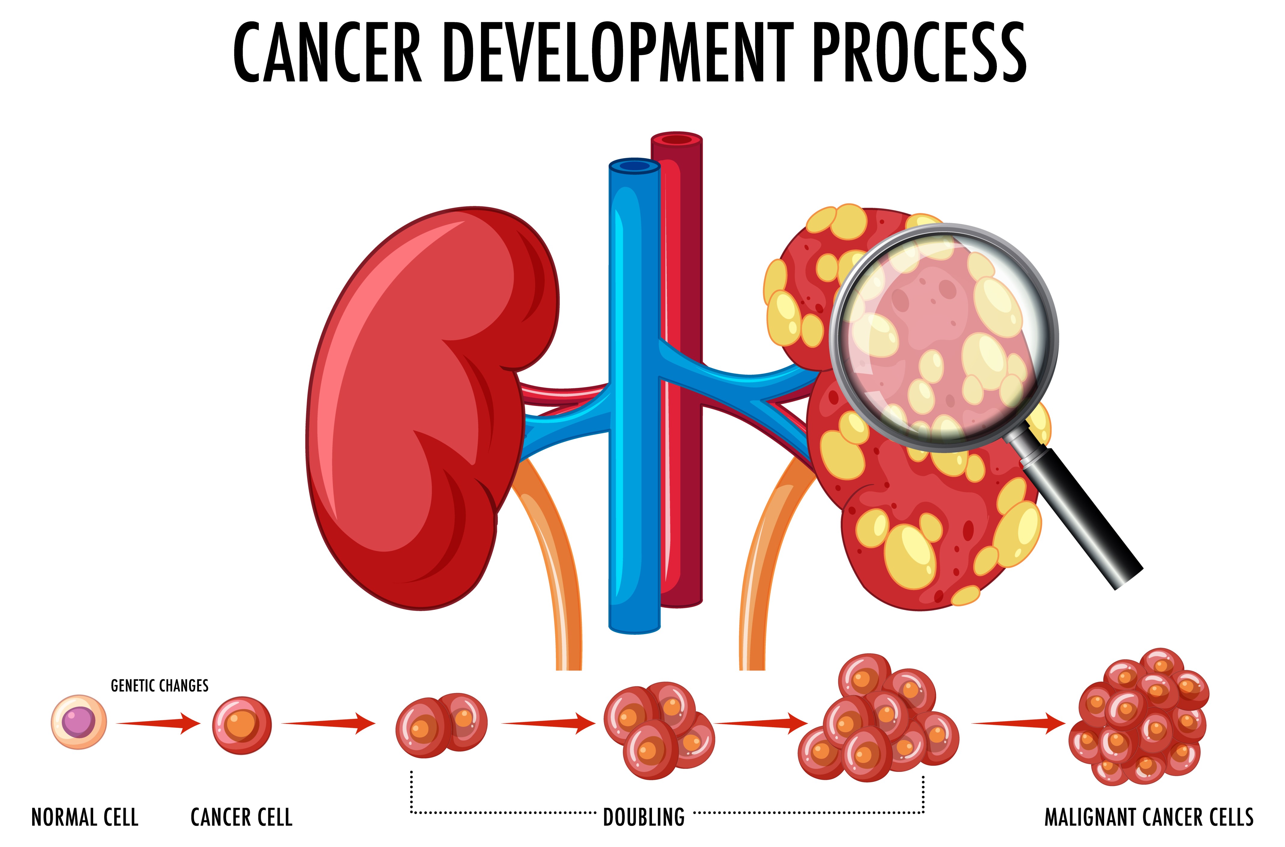 Best kidney cancer doctor in warangal